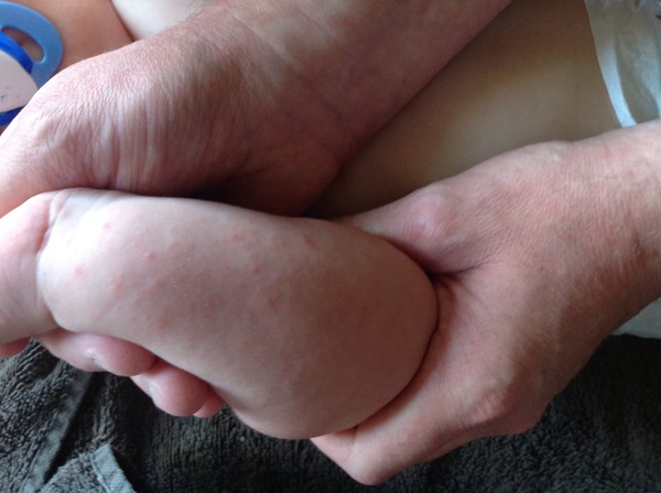 What's this rash?