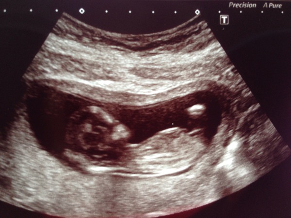 Jan 2016 #4 - heading for the end of the 1st trimester with dating scans and wacky dreams