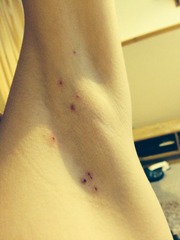 trying to get rid of molluscum