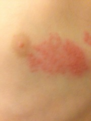 Any ideas please what this rash could be?