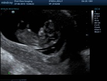 Jan 2016 #5 - Scanxiety, sickness and sweet relief as we approach the second trimester!