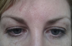 Anyone had tear trough fillers