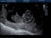 Jan 2016 #5 - Scanxiety, sickness and sweet relief as we approach the second trimester!