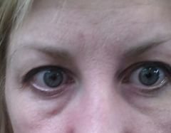 Anyone had tear trough fillers