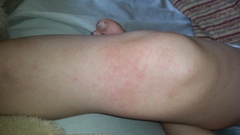 Weird rash,poorly DS - help me diagnose please.