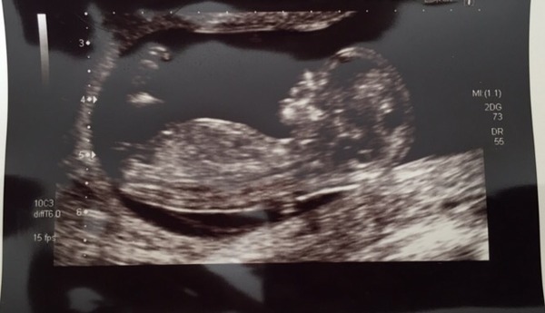 12 week scan gender guess