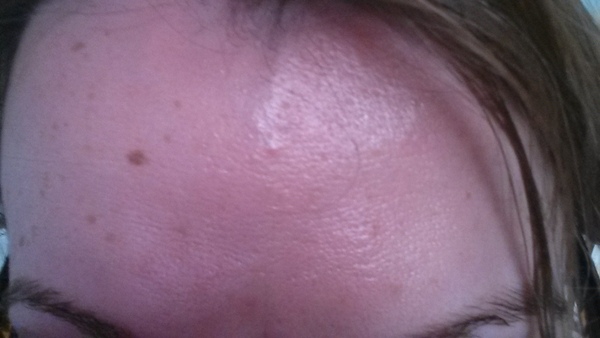 to be suspicious of older women with totally smooth foreheads!