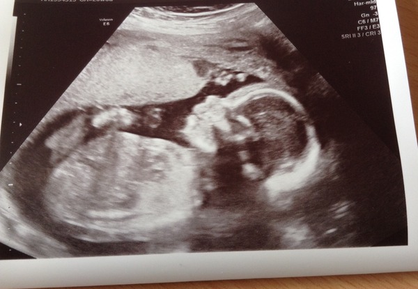RESPONSE Trial for recurrent miscarriage: Thread#3