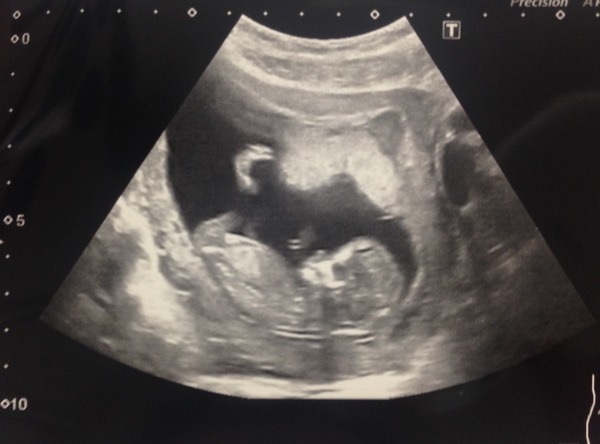 Jan 2016 #6 ....bumps and blooming ahoy!