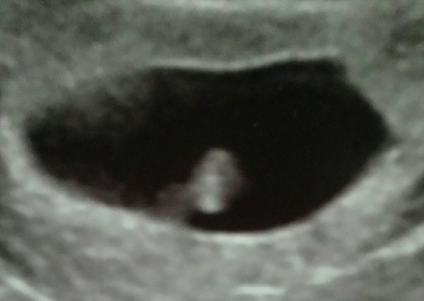 RESPONSE Trial for recurrent miscarriage: Thread#3