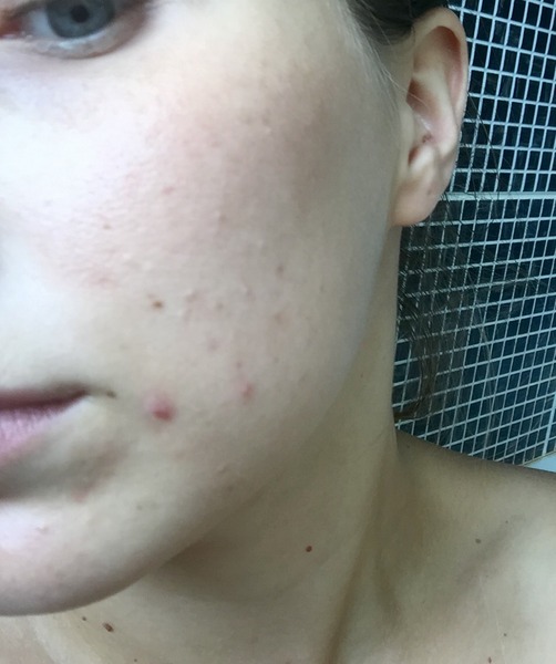 Clogged pores? Need help, pic inc.