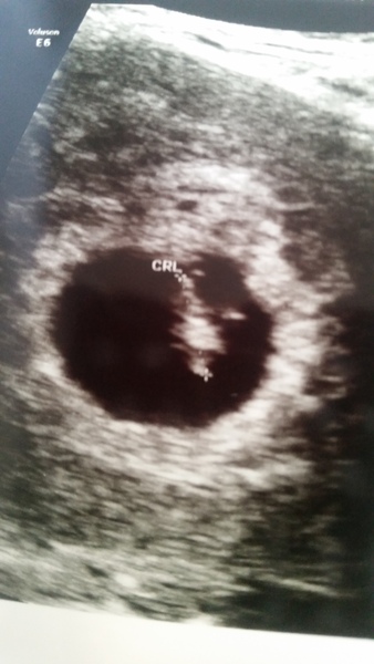 RESPONSE Trial for recurrent miscarriage: Thread#3