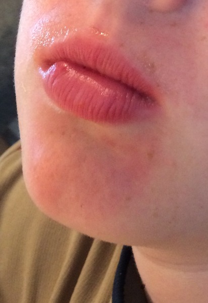Strange Purple Rash on DD3's chin - should I be worried?