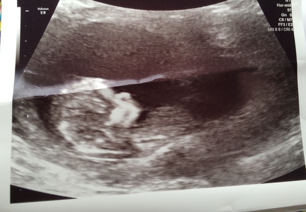 1:47 on combined test. 20 week loss last year. Very scared!