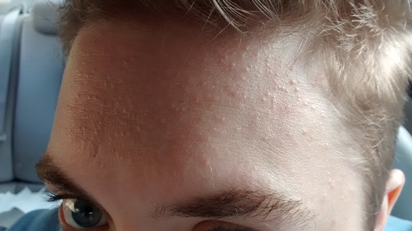 Help! What on earth has happened to my skin? (With picture.)