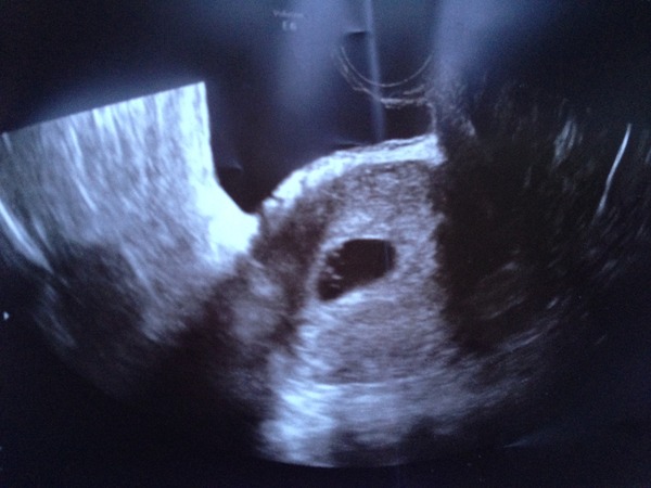 7wks 5days - early scan inconclusive - what are my chances?