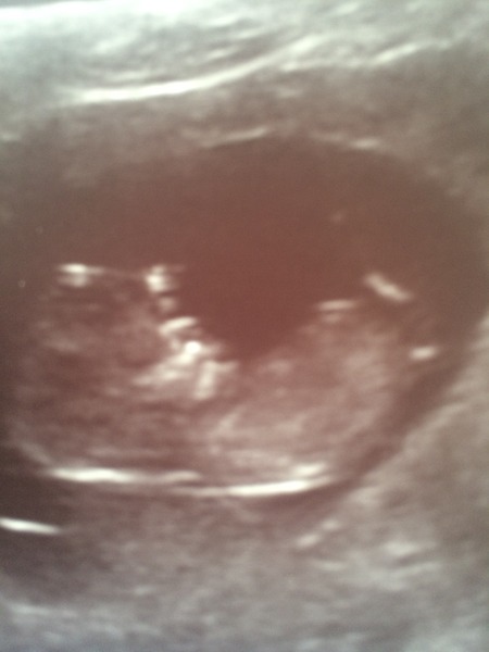 12 week scan boy or girl?
