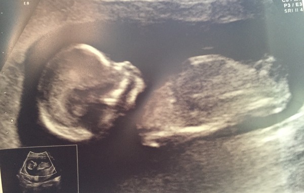 Gender guess? Girl or boy? Nub or skull?