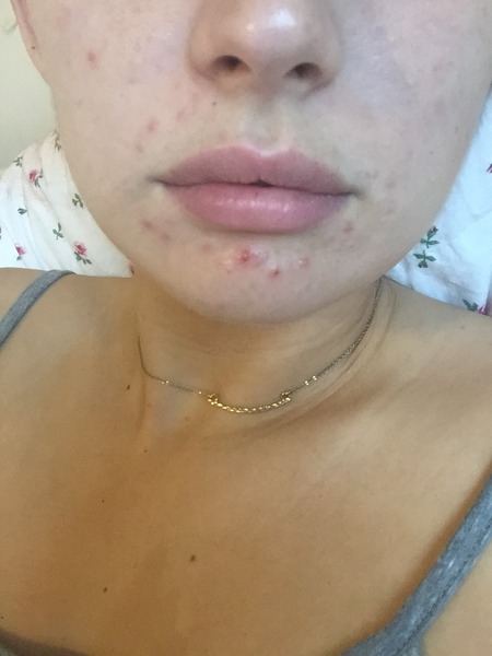Best products for itchy, spots under the skin