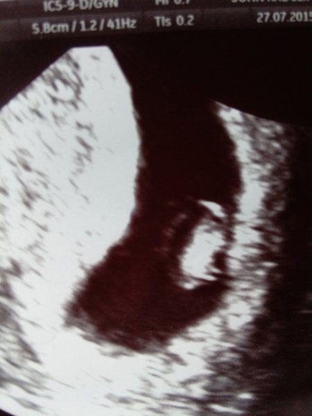 March 2016 bus chugging along, sickness and early scans galore!