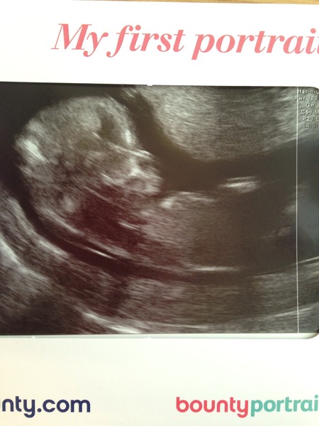 RESPONSE Trial for recurrent miscarriage: Thread#3