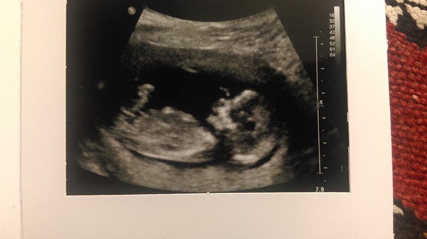 Jan 2016 #5 - Scanxiety, sickness and sweet relief as we approach the second trimester!