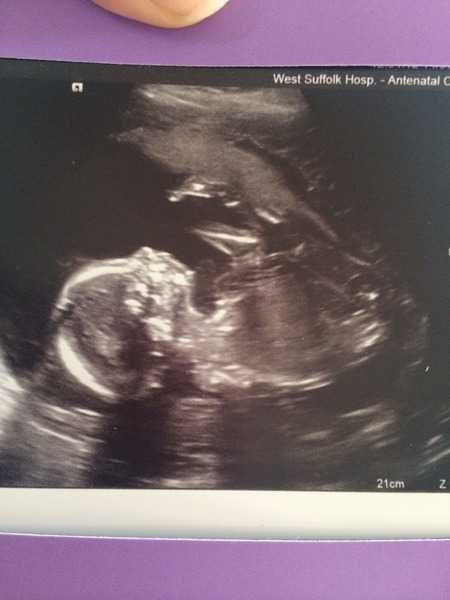 Plenty of chocolate and support all round - #5 posifrickintive thread for those pregnant after miscarriage