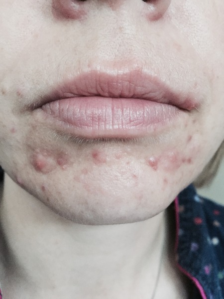 Best products for itchy, spots under the skin