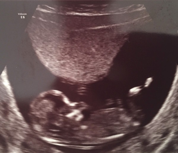 Jan 2016 #5 - Scanxiety, sickness and sweet relief as we approach the second trimester!