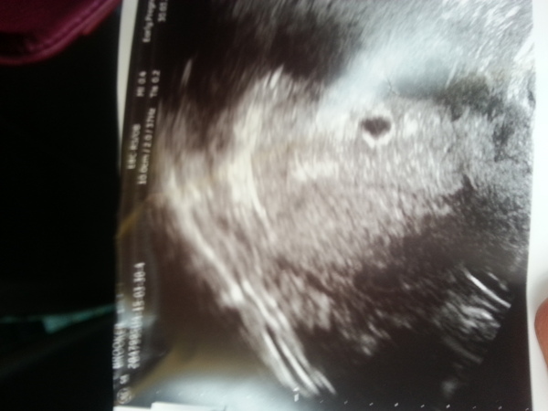 7wks 5days - early scan inconclusive - what are my chances?