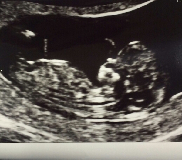 Jan 2016 #5 - Scanxiety, sickness and sweet relief as we approach the second trimester!