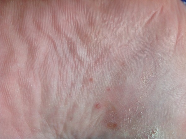 Are these verrucas/i? What about Footner?