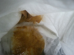 taadaa shiny new gastrostomy support thread no.3 tube feeding support