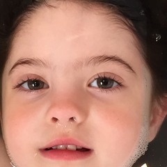 Any hints/tips to prevent scarring (DDs forehead deep cut)