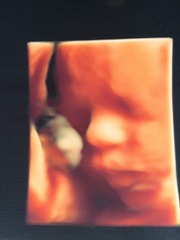 RESPONSE Trial for recurrent miscarriage: Thread#3