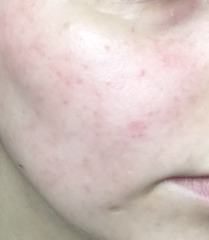 Is this melasma? Rosacea? Please help!