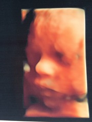 RESPONSE Trial for recurrent miscarriage: Thread#3
