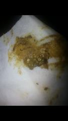 taadaa shiny new gastrostomy support thread no.3 tube feeding support