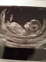 Jan 2016 #5 - Scanxiety, sickness and sweet relief as we approach the second trimester!