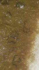 taadaa shiny new gastrostomy support thread no.3 tube feeding support