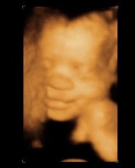 RESPONSE Trial for recurrent miscarriage: Thread#3