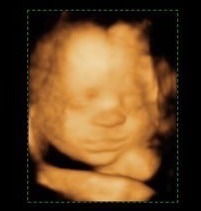 RESPONSE Trial for recurrent miscarriage: Thread#3