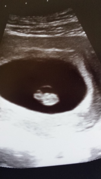 RESPONSE Trial for Recurrent Miscarriage - Thread 4