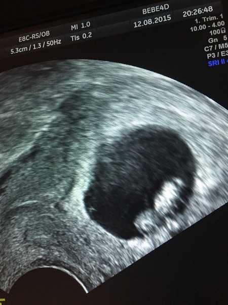 Low HCG at 5weeks+5 very worried!