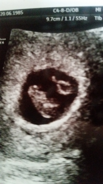 RESPONSE Trial for Recurrent Miscarriage - Thread 4