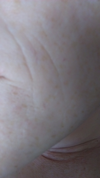 facial crevice....how much filler do i need...pic!