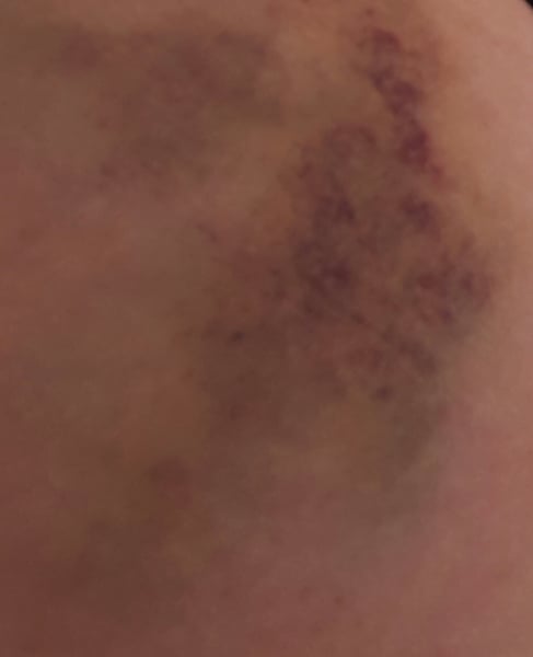 RESPONSE Trial for Recurrent Miscarriage - Thread 4