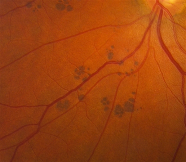 Does anybody have a freckle behind their eye?