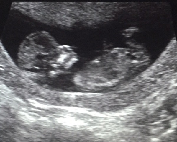 March 2016 Babies!! Our Grape-sized babies are getting Bigger!