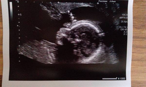 Jan 2016 #8 Enjoying second trimester and 20 week scans